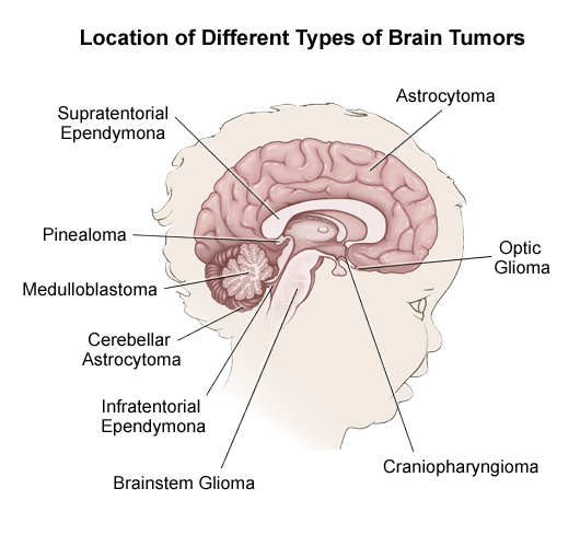 Work personally Brain tumor symptoms in adults Public